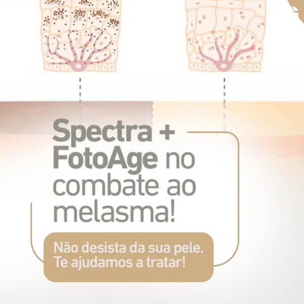 Spectra + FotoAge no combate ao melasma!