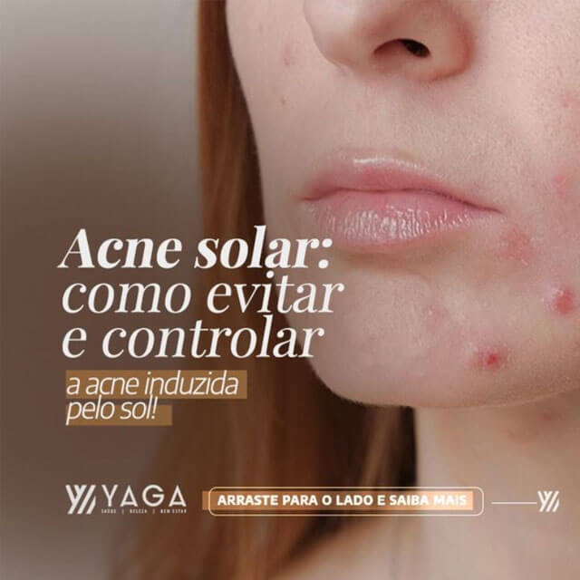 Acne Solar: Como evitar e controlar a acne induzida pelo sol!