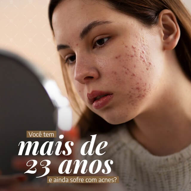 Você tem mais de 23 anos e ainda sofre com acnes?