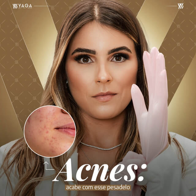 Acnes: acabe com esse pesadelo