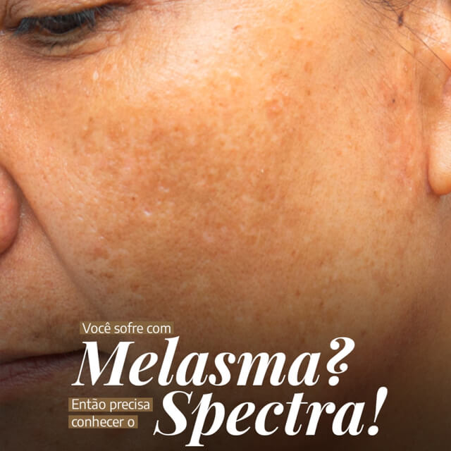 Você sofre com melasma? Então precisa conhecer o Spectra!