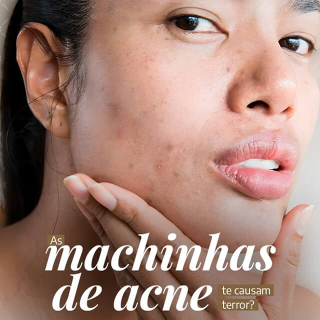 As manchinhas de acne te causam terror?