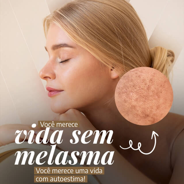 Você merece vida sem melasma, você merece uma vida com autoestima!