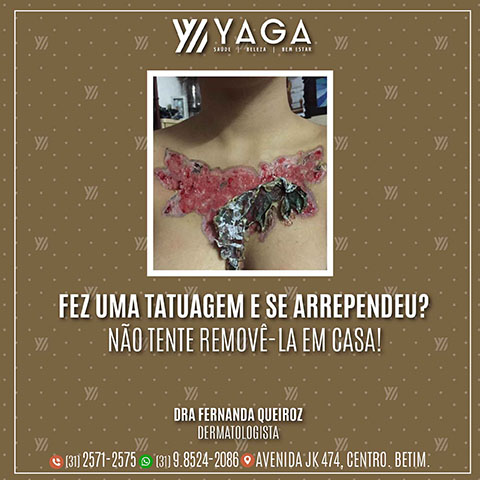 Fez uma tatuagem e se arrependeu? Não tente removê-la em casa!