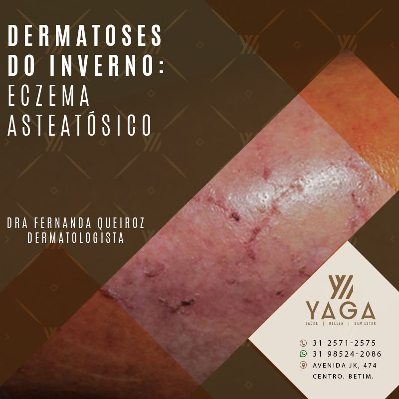 Dermatoses do inverno: Eczema Asteatósico
