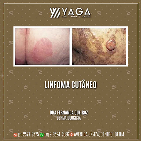 Linfoma Cutâneo
