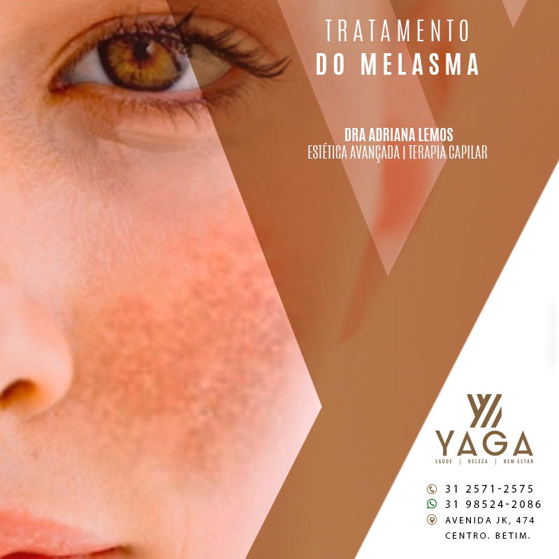 Tratamento do Melasma