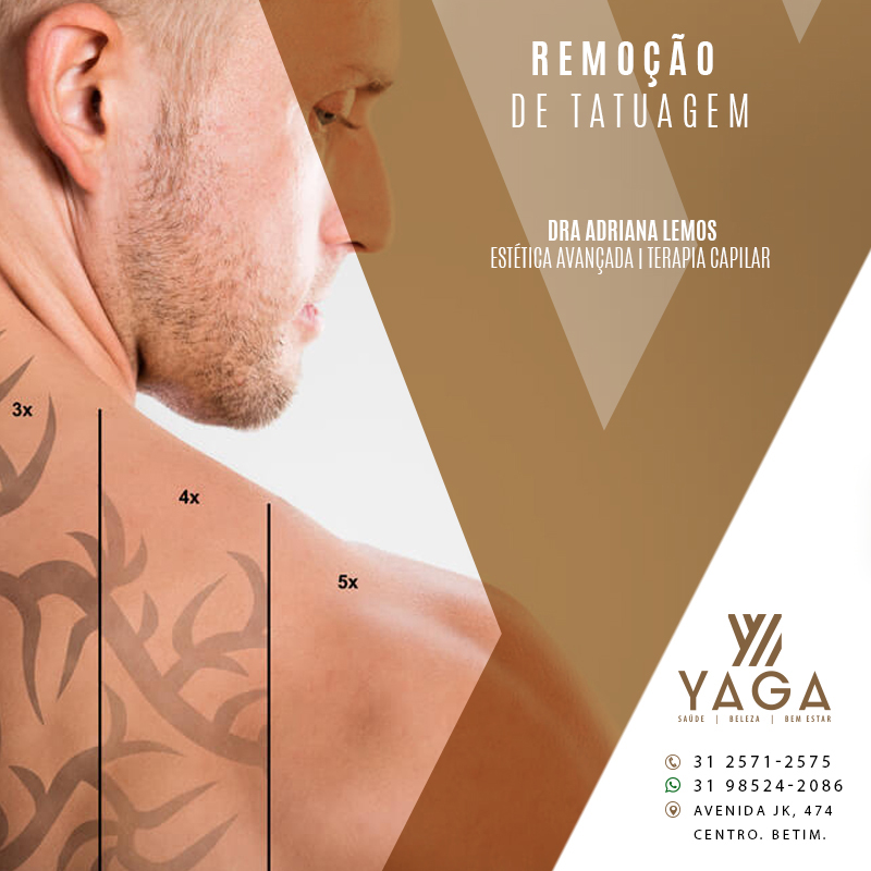 Remo&ccedil;&atilde;o da Tatuagem