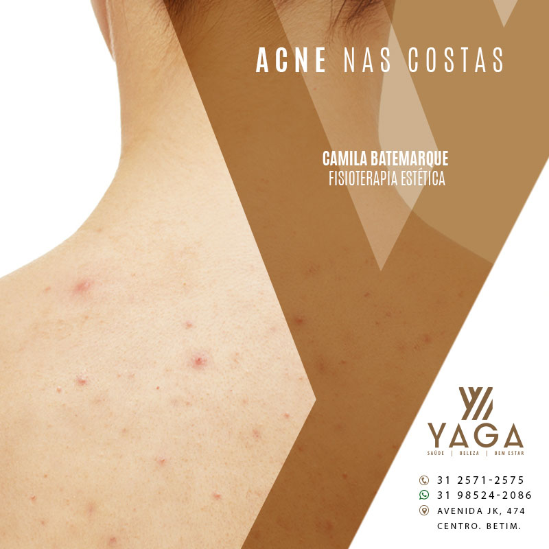 Acne nas Costas