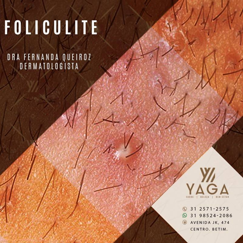 Foliculite