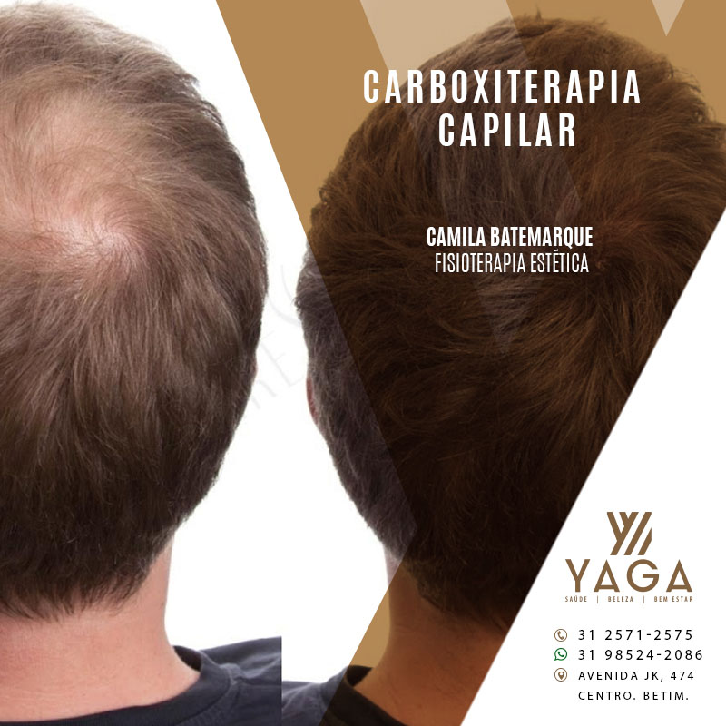 Carboxiterapia Capilar