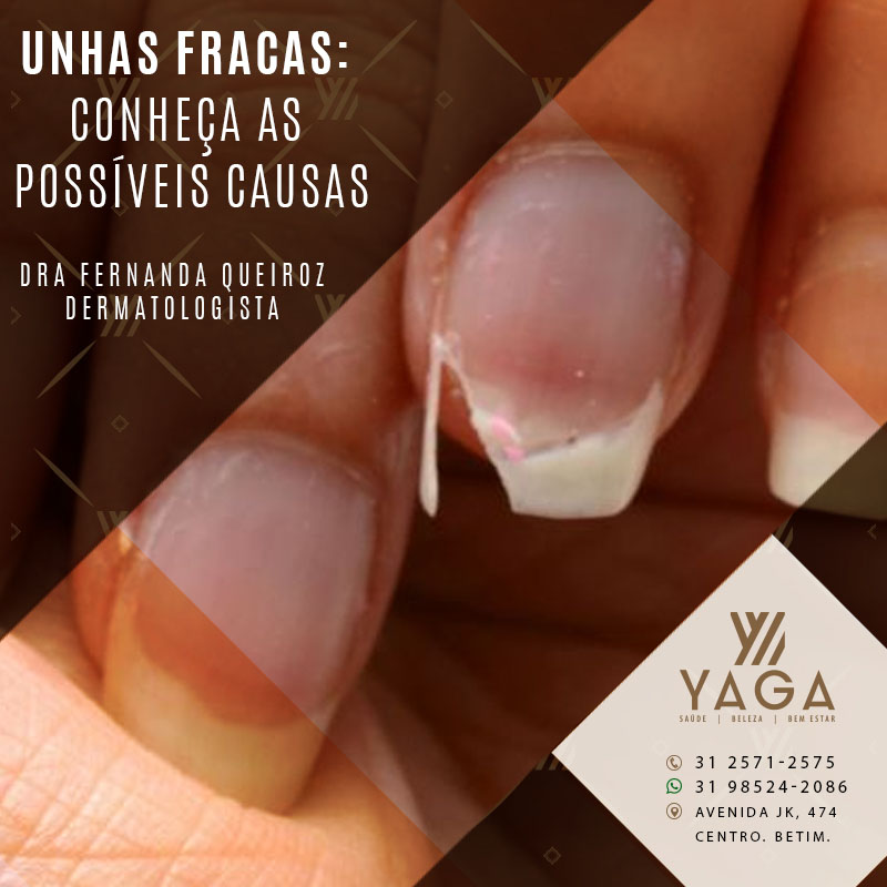 Unhas fracas: conhe&ccedil;a as poss&iacute;veis causas