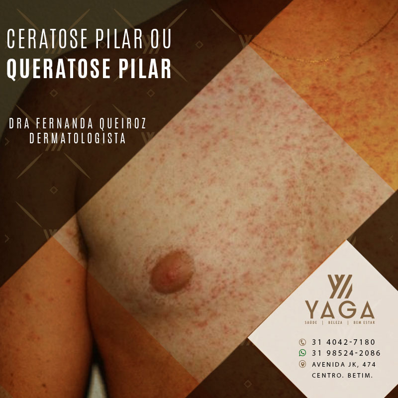 Ceratose Pilar ou Queratose Pilar
