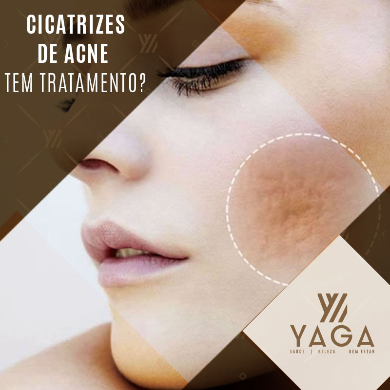 Cicatrizes de acne tem tratamento?