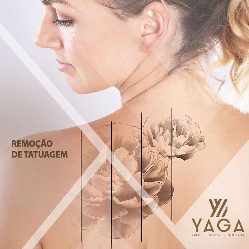 Remo&ccedil;&atilde;o de tatuagem