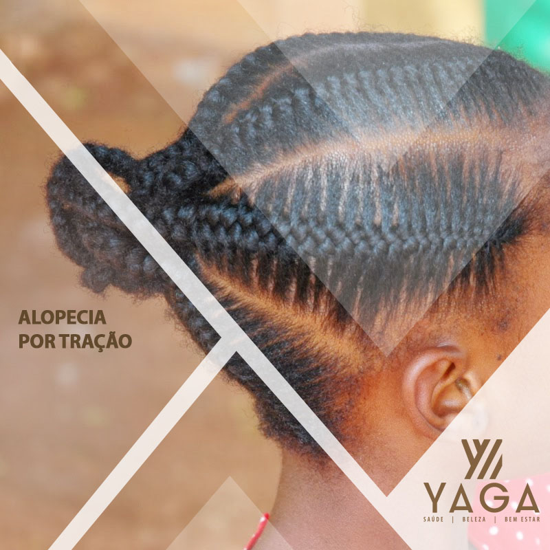 Alopecia por tração