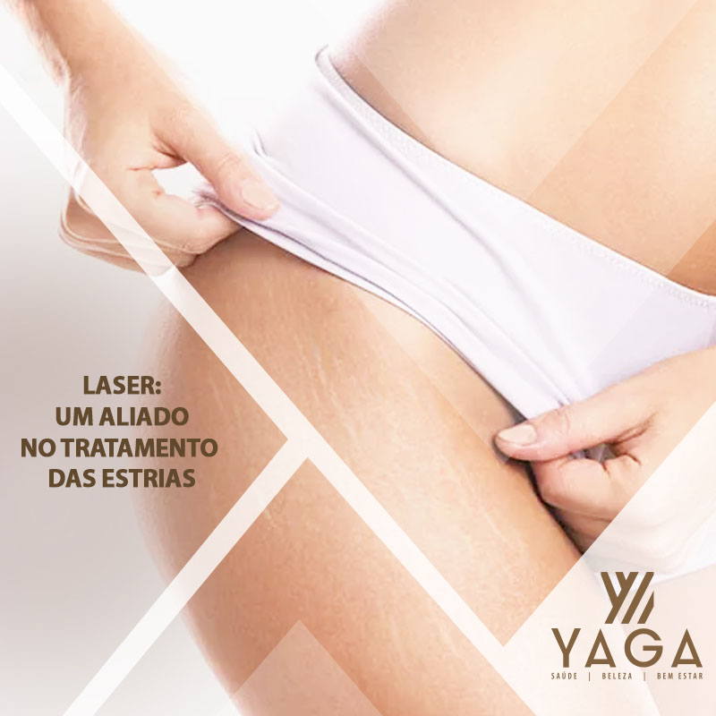 Laser: um aliado no tratamento das estrias