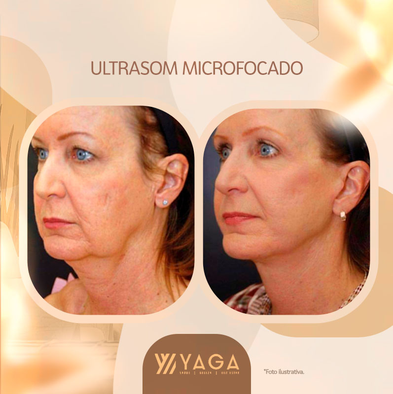 Ultrasom microfocado