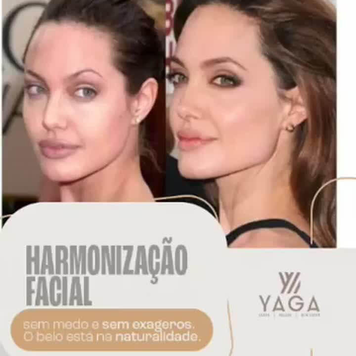 Harmonização facial sem medos e sem exageros